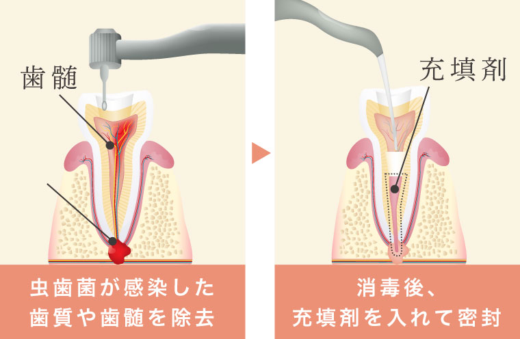 虫歯菌が感染した歯質や歯髄を除去 消毒後、充填剤を入れて密封