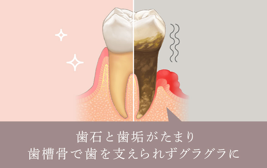 歯石と歯垢がたまり歯槽骨で歯を支えられずグラグラに